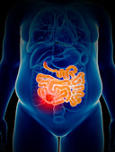 Illustration of bowel cancer