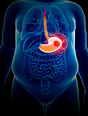 Illustration of stomach cancer