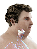 Illustration of an obese man's larynx