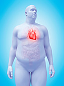 Illustration of an obese man's heart