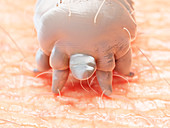 Illustration of a scabies mite on human skin