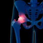 Illustration of a painful hip joint