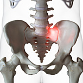 Illustration of a painful sacrum joint