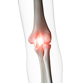 Illustration of a painful elbow joint