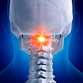 Illustration of a painful atlas vertebrae
