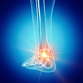 Illustration of a painful ankle