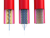 Illustration of a stent being placed