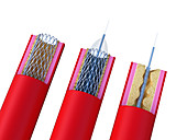 Illustration of a stent being placed