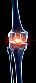 Illustration of a painful knee joint