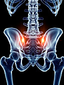 Illustration of painful sacrum joints