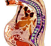 Spine in ankylosing spondylitis, X-ray