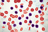 Acute lymphoblastic leukaemia, illustration