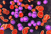 Acute lymphoblastic leukaemia smear, illustration