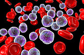 Acute lymphoblastic leukaemia smear, illustration