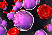 Acute lymphoblastic leukaemia smear, illustration