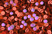 Acute lymphoblastic leukaemia smear, illustration