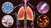 Bacteria that cause nosocomial pneumonia, illustration