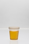 Urine sample in plastic cup