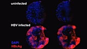 Hepatitis B infection in artificial liver research