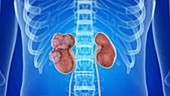 Tumours in the kidney