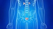 Tumours in the bladder