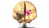 Cerebral haemorrhage, animation