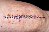 Knee replacement scar