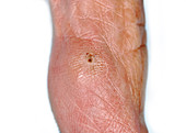 Splinter injury to a thumb