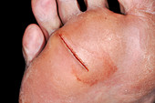 Laceration to sole of foot