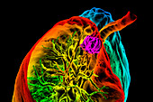 Lung cancer,3D CT scan
