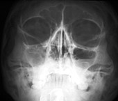 Sinusitis,X-ray