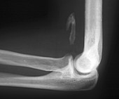 Osteoma,X-ray