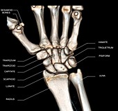 Normal wrist,3D CT scan