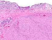 Follicular dendritic cell sarcoma,light micrograph