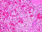 Hairy cell leukaemia,light micrograph