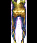 Bilateral knee osteoarthritis,X-ray
