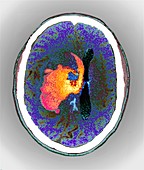 Intraparenchymal haemorrhage,CT scan