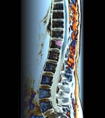 Secondary bone cancer in the spine,MRI scan