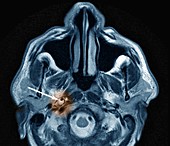 Right hemisphere stroke,MRI scan