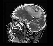 Secondary brain cancer,MRI scan