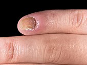 Candidiasis of a fingernail