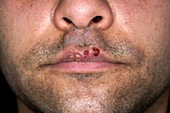 Herpes simplex infection