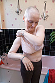 Woman who has had a mastectomy and chemotherapy dressing
