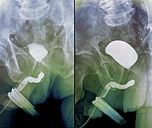 Bladder after prostate removal,X-ray