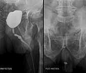 Bladder after prostate removal,X-ray