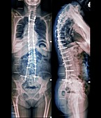 Corrected spine in osteoarthritis,X-rays