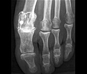 Treatment in osteoarthritis of the foot,Xray