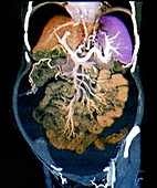 Swollen abdomen in cirrhosis,CT scan