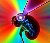 Kidney cancer radiotherapy,illustration