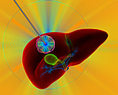 Liver cancer thermal ablation,illustration